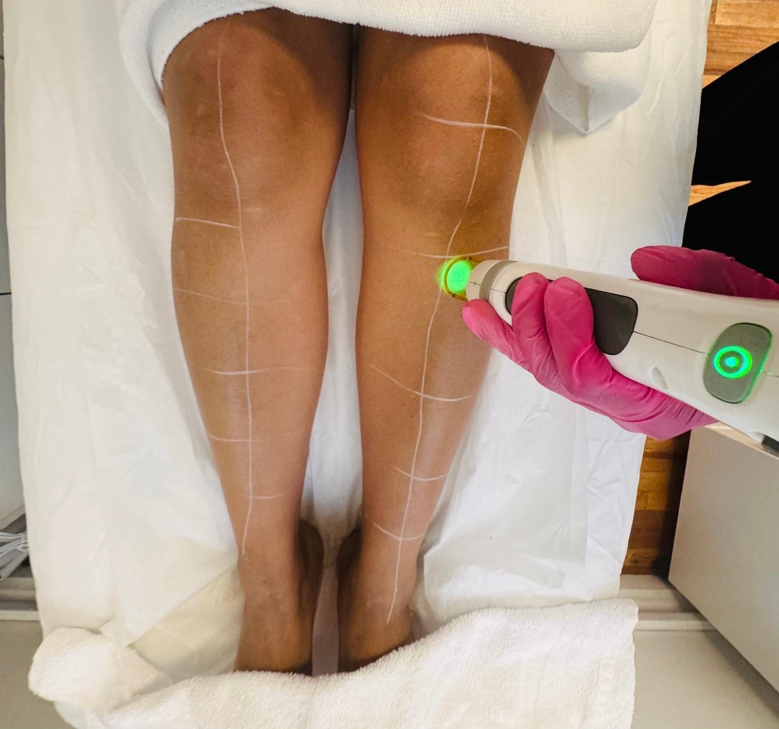 Leg laser treatment